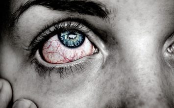 Vnetje očesnih vek ali blefaritis – kako zdravimo vnetje?